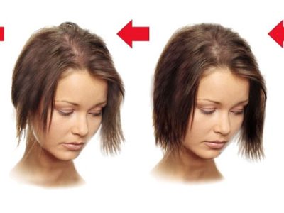 Сильное выпадение волос со временем может привести к облысению