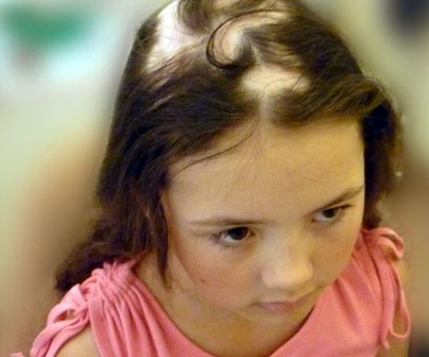 Выпадение волос ребенок 3 года
