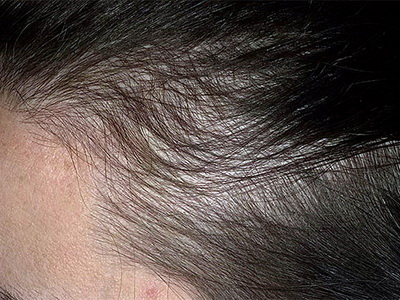 Препарат для лечения диффузного выпадения волос thumbnail