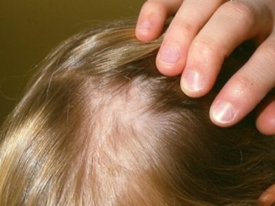 Народные средства при выпадении волос у детей thumbnail