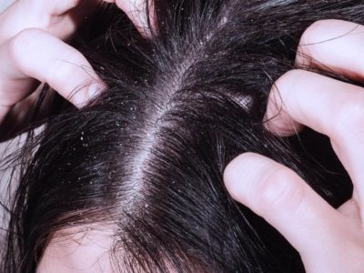 Лечение сухой себореи кожи головы народными средствами 