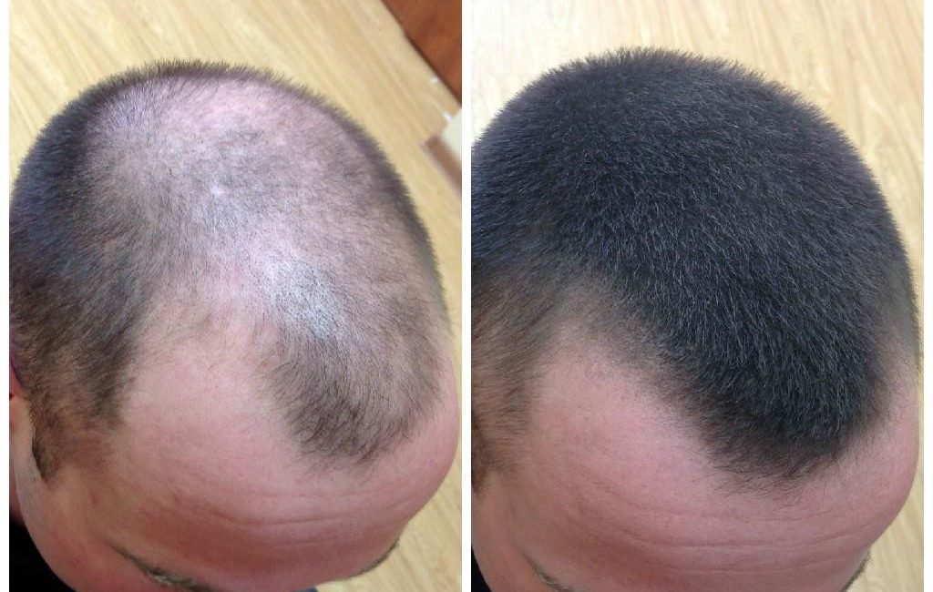 Как вылечить выпадение волос у мужчины в домашних условиях thumbnail