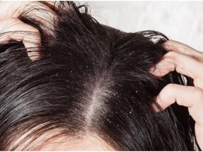 Появление перхоти ухудшает состояние волос и приносит неприятные ощущения