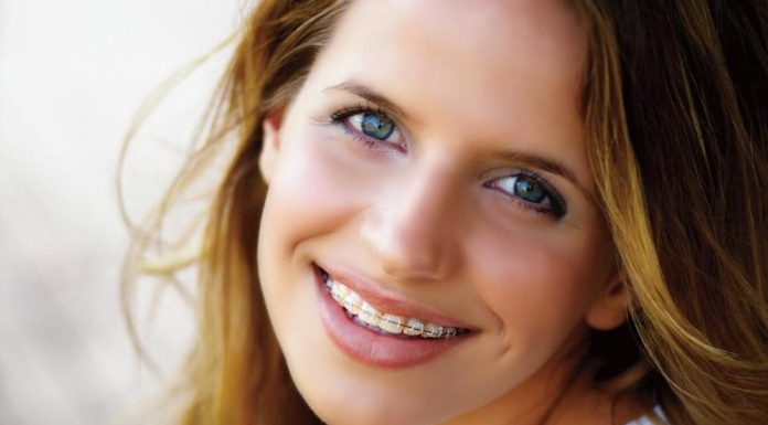 Для каких целей устанавливаются брекеты