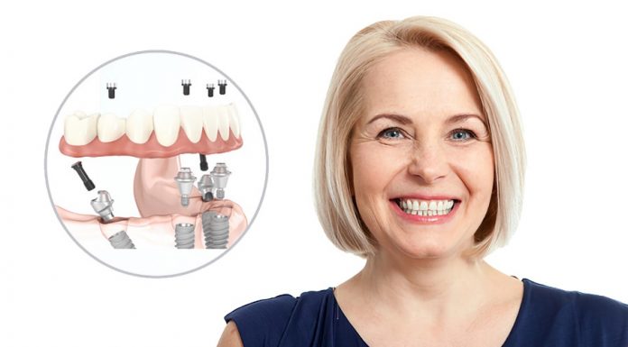 Имплантация All-on-4