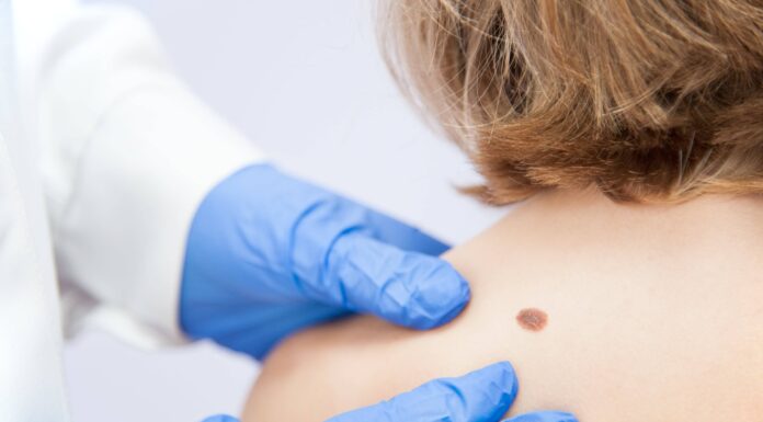 Причины и симптомы появления бородавок