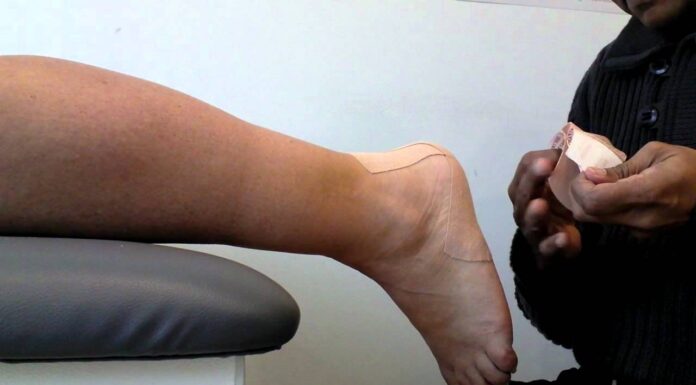 Как проявляется бурсит пятки и что против него помогает