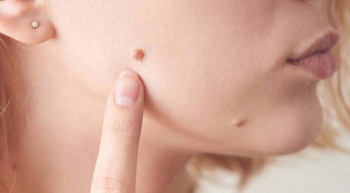 Где качественно удалить бородавки: что это, типы бородавок, причины появления, способы удаления и особенности избавления от бородавок