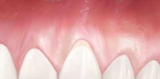 Пародонтоз — заболевание зубов