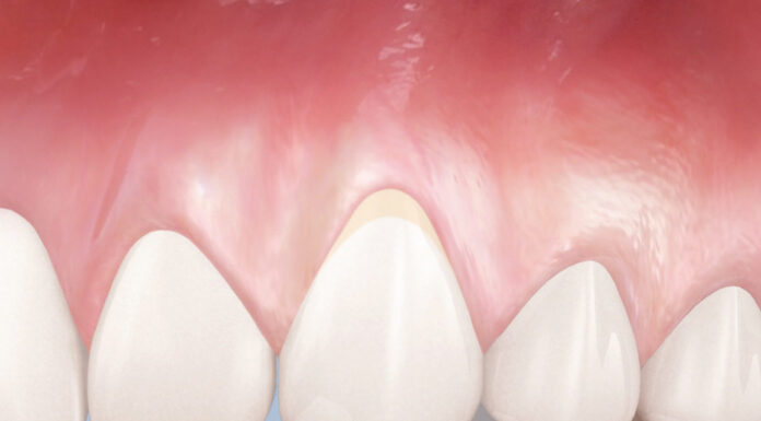 Пародонтоз — заболевание зубов