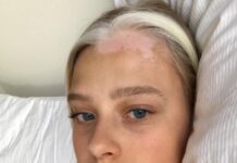 Витилиго на волосах: курс лечения