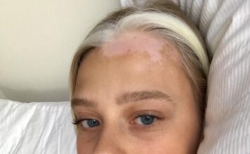 Витилиго на волосах: курс лечения