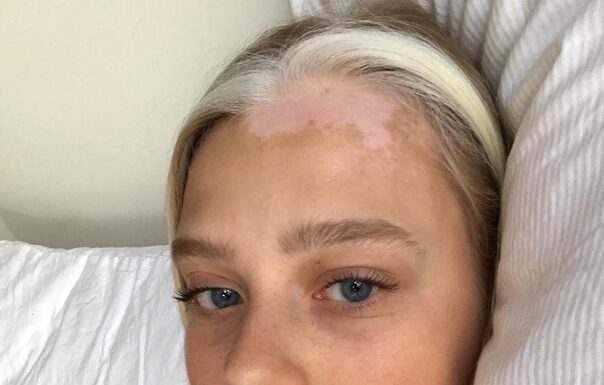 Витилиго на волосах: курс лечения