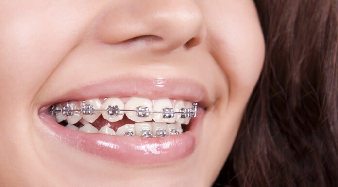 Какими встречаются брекеты?