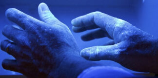 Лечение псориаза ультрафиолетом: в чем имеются плюсы ультрафиолетового прибора, имеются ли противопоказания, как пользоваться ультрафиолетовым прибором, как переносится лечение ультрафиолетовой лампой