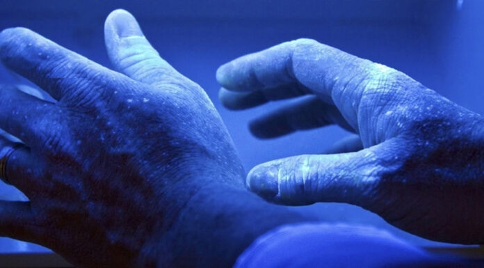 Лечение псориаза ультрафиолетом: в чем имеются плюсы ультрафиолетового прибора, имеются ли противопоказания, как пользоваться ультрафиолетовым прибором, как переносится лечение ультрафиолетовой лампой