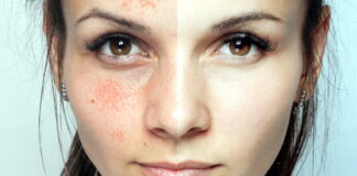 Пилинг Джесснера