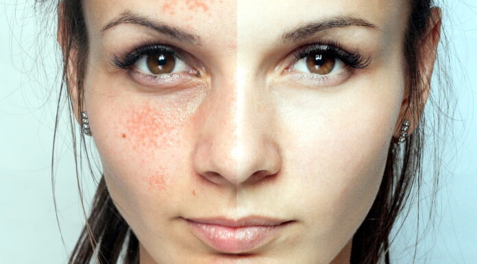 Пилинг Джесснера