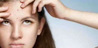 Прыщи на лбу — что с ними делать?