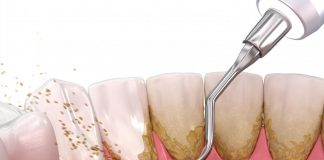 Почему важно чистить зубы тщательно и что делать, если с зубами возникли проблемы: ультразвуковая чистка зубов