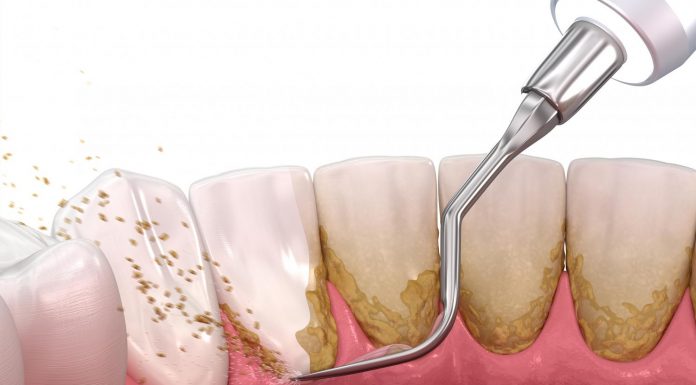 Почему важно чистить зубы тщательно и что делать, если с зубами возникли проблемы: ультразвуковая чистка зубов