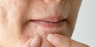 Прыщи на губе: откуда они появляются
