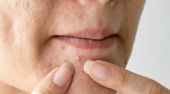 Прыщи на губе: откуда они появляются