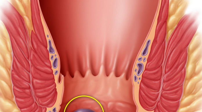 Геморрой у беременных: процесс возникновения, неудобства, лечение