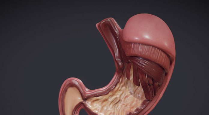 Бариатрическая хирургия: желудочный бандаж, билиопанкреатическое шунтирование, частичное шунтирование