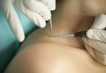 Удаление папиллом: справка и рекомендации