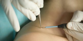 Удаление папиллом: справка и рекомендации