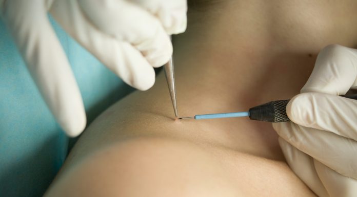 Удаление папиллом: справка и рекомендации