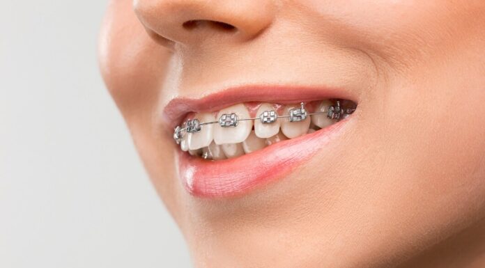 Ортодонтия: исправление прикуса и создание идеальной улыбки
