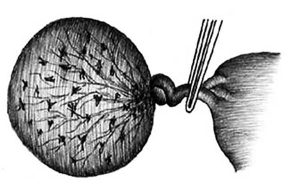Перекрут ножки кисты яичника: симптомы, диагностика и методы лечения