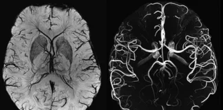 Что такое МРТ артерий головного мозга: когда его используют