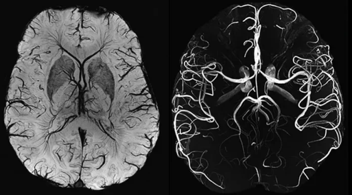 Что такое МРТ артерий головного мозга: когда его используют