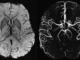 Что такое МРТ артерий головного мозга: когда его используют